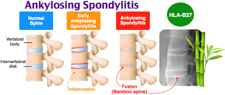 found-on-google-from-rehabmypatient-ankylosing-spondylitis-vertebrae