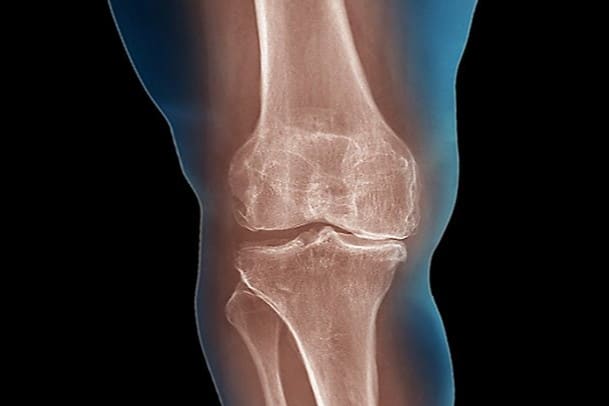 Why Losing 10+ Pounds Can Be One of the Best Treatments for Knee ...