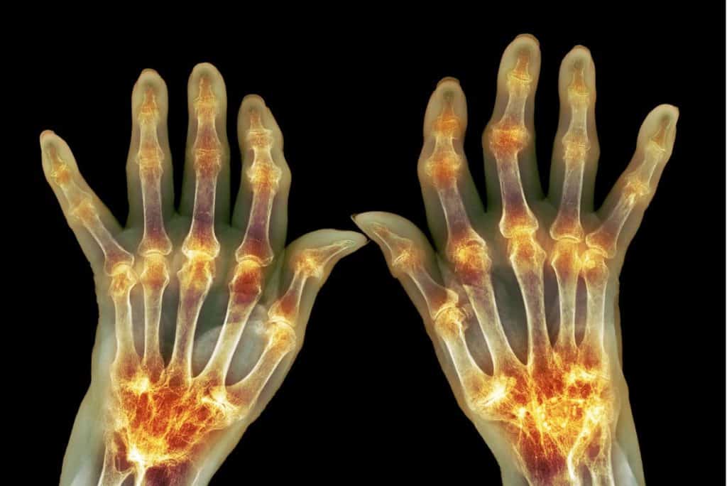 5-easy-ways-to-help-you-manage-hand-osteoarthritis-tristate