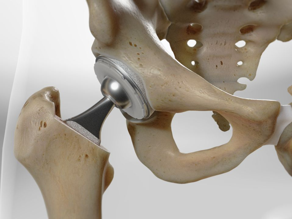 6 Important Questions To Ask When Choosing A Hip Replacement Surgeon