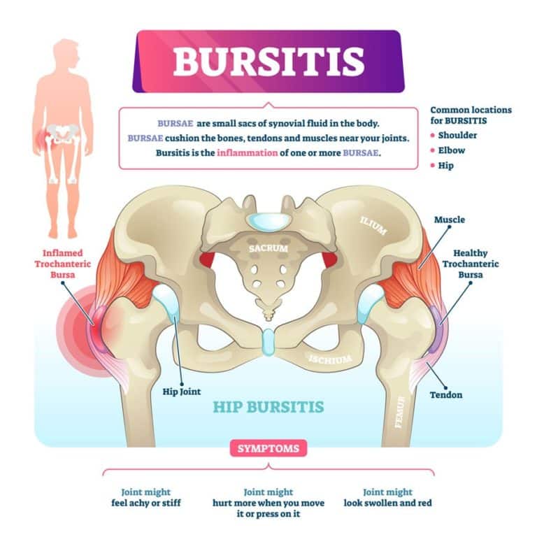 The Causes, Symptoms, and Treatments For Bursitis Hip, Elbow, and ...
