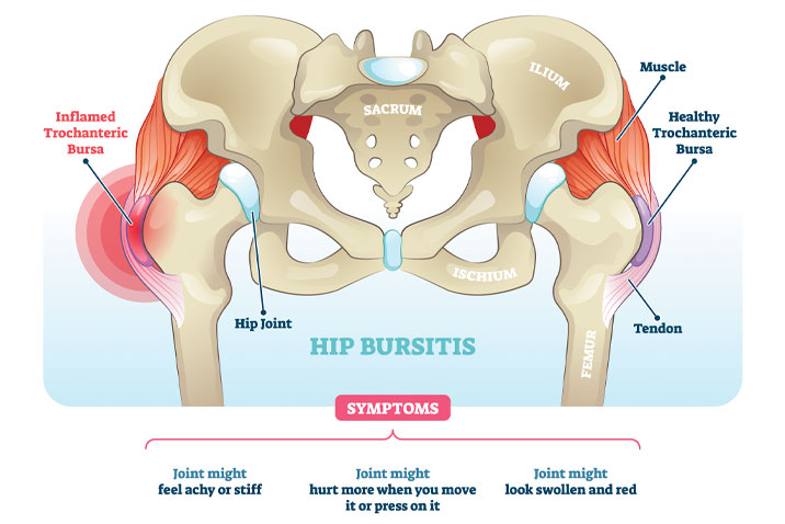 Trochanteric bursitis: Causes and treatment of hip bursitis